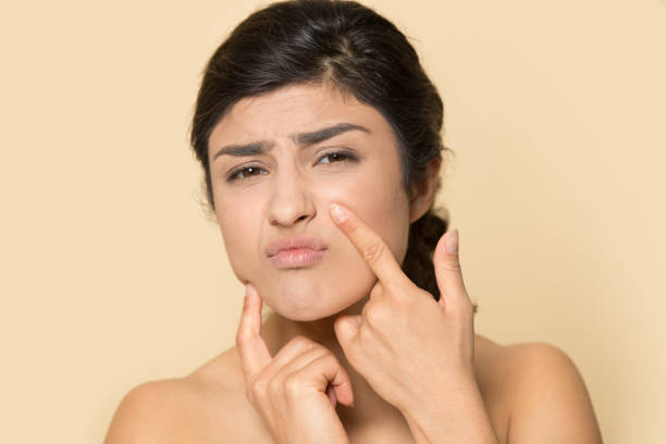 Best Acne Treatment in Wagholi Pune